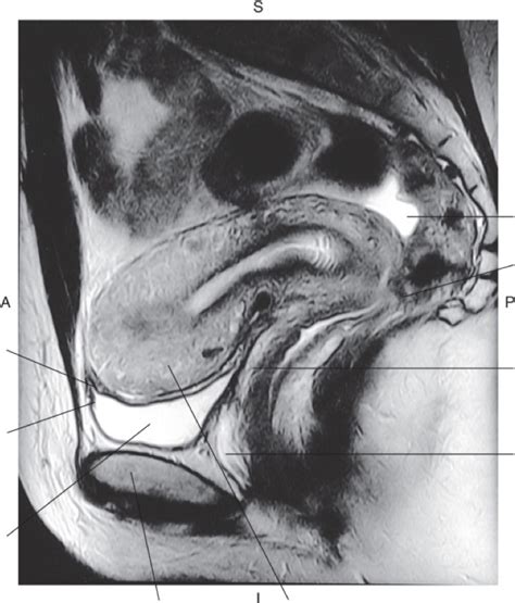 Female Pelvic Cavity Sagittal Plane Labeling Diagram Quizlet