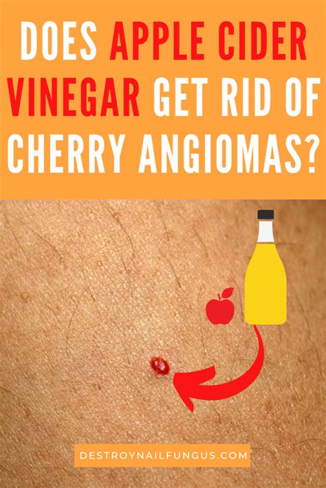 Cherry Angioma Removal: Apple Cider Vinegar And Other Home Remedies