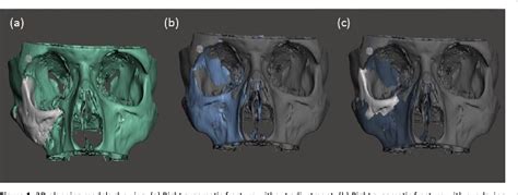 Figure 1 From A Minimal Access Zygomatic Osteotomy Technique For The