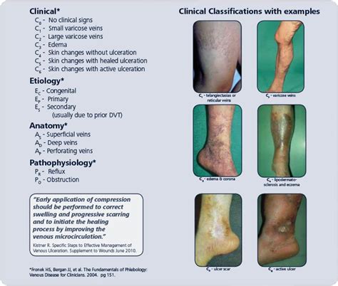 Vein Classifications