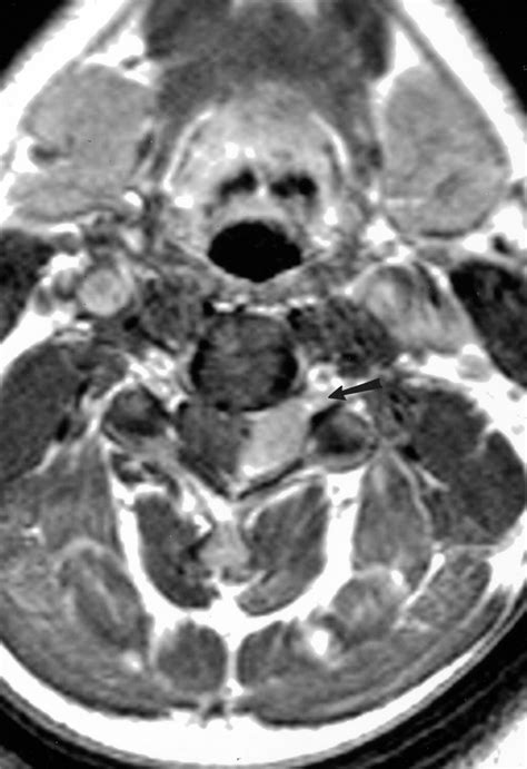 Diffusion Weighted Mr Imaging In A Patient With Spinal Meningioma Ajr