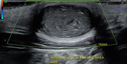 Epidermal inclusion cyst | Radiology Case | Radiopaedia.org