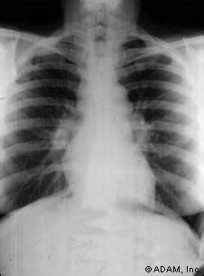 Pulmonary Sarcoid On Cervical Spine X Ray Golfani