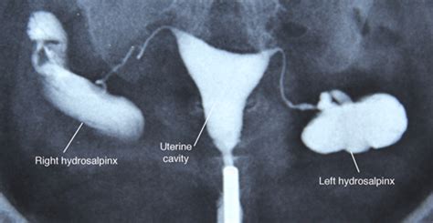 Understanding Hydrosalpinx: Causes, Symptoms, and Treatment Options ...