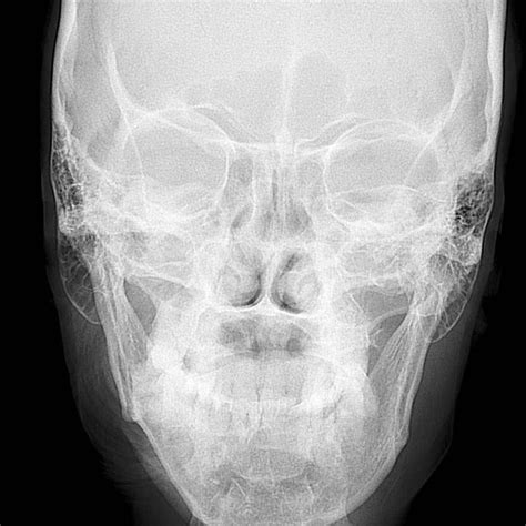 Orthopantomograph Showing Prominent Antegonial Notch On The Right Side