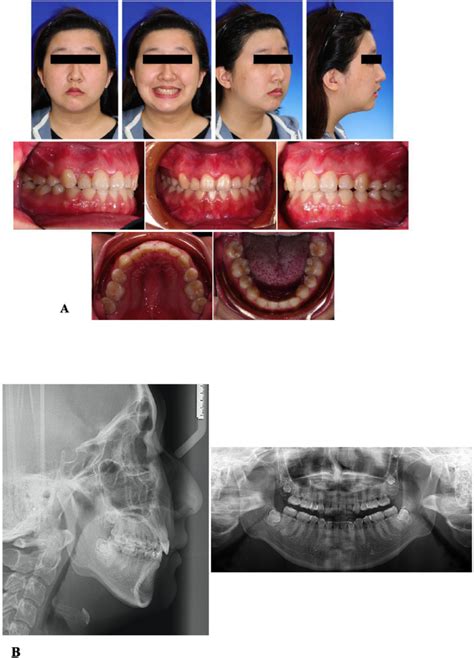 A The Pretreatment Extraoral And Intraoral Photographs Showing