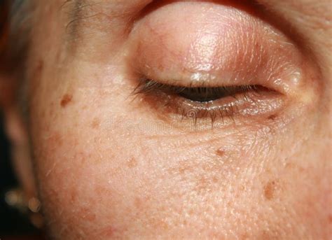 Blue Nevus Eyelid