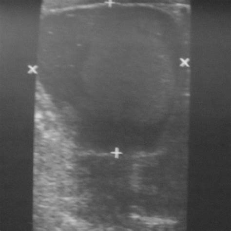 Ultrasonographic Appearance Of Dermoid Cyst Download Scientific Diagram