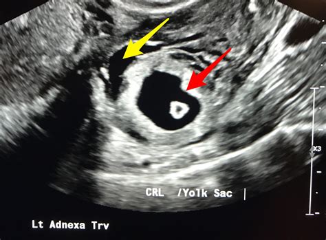 Ovarian Ectopic Pregnancy Ultrasound