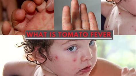 What Is Tomato Flu Or Tomato Fever Symptoms Causes Prevention