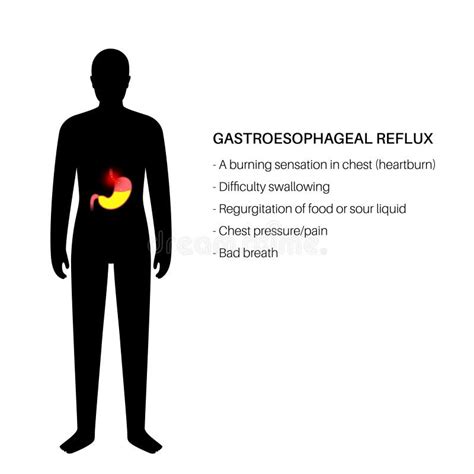 Gastroesophageal Reflux Disease Stock Vector Illustration Of