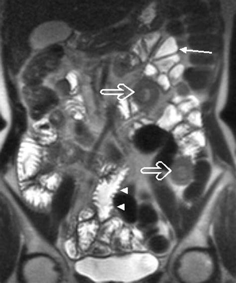 Adult Celiac Disease What Is The Role Of Mri Tomei 2006 Journal