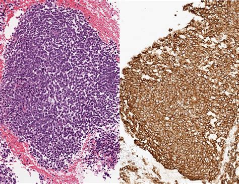 Pathology Outlines Cd99