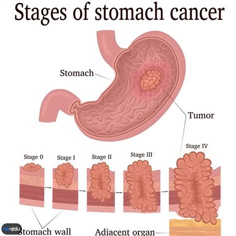 Mide Kanseri Belirtileri Nelerdir Evreleri ve Ameliyatı