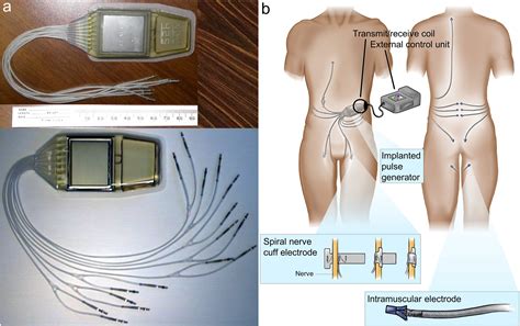 Implanted Pulse Generators In Lower Extremity Neuroprostheses A 25 Year Review Neuromodulation