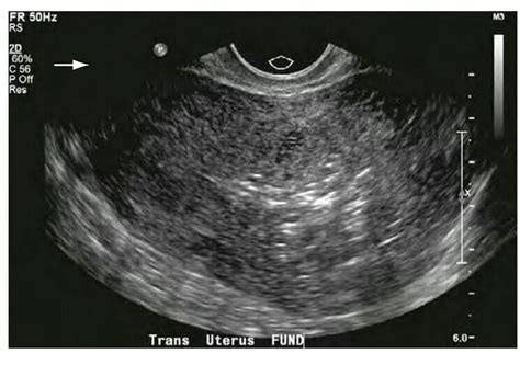 Transvaginal Ultrasound Features Of Normal Uterosacral Hot Sex Picture