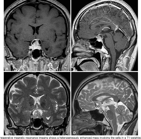 Figure 1 From Adult Onset Sellar And Suprasellar Atypical Teratoid