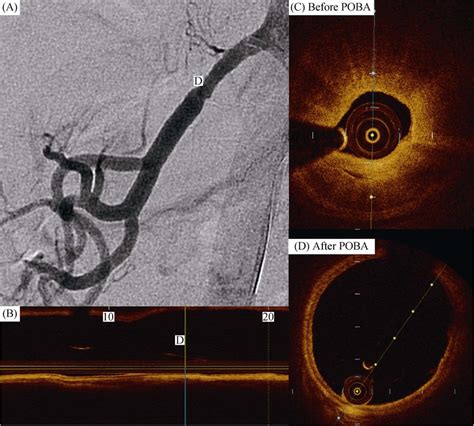 Final Angiogram Post Balloon Angioplasty Showed Enlargement Of The