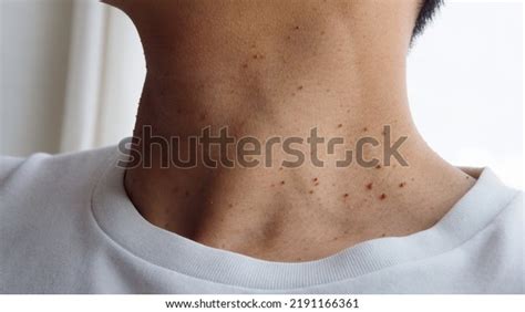 21 Small Cyst On Neck Images, Stock Photos, 3D objects, & Vectors | Shutterstock