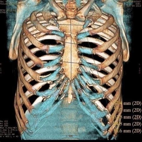 Ct Scan Image Depicting Linear Measurements Of Sternum Download