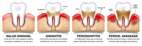 Periodoncia Clínica Dental En Mallorca Clínica Áureo