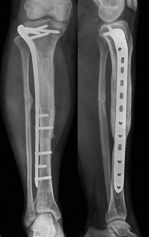 Bone Transport With An External Fixator And A Locking Plate For