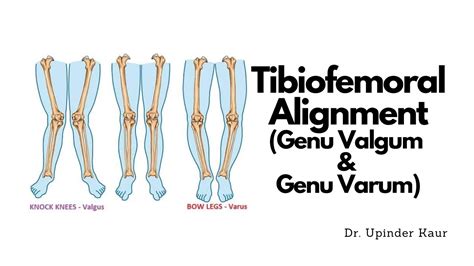 Tibiofemoral Alignment Genu Valgum Genu Varum Youtube