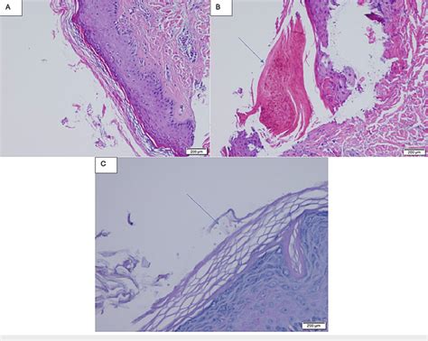 First Skin Biopsy A Orthokeratosis And Parakeratosis B