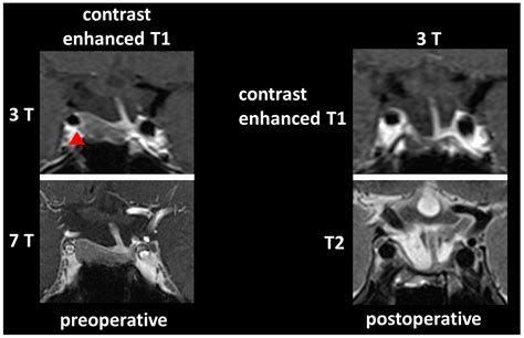 Improved Detection Of Cavernous Sinus Invasion Of Pituitary