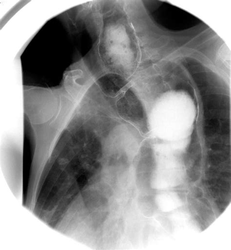 Figure From With Achalasia An Uncommon Event Cervical Tracheal