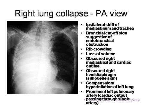 Advanced Tracheal Collapse