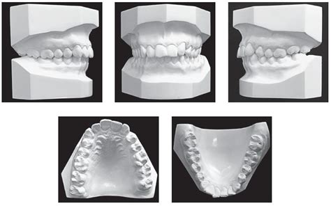 Scielo Brasil Agenesis Of Maxillary Lateral Incisor In An Angle Class