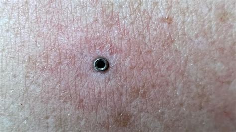 COMO QUITAR UN MICRODERMAL EN 3 SEGUNDOS SIN HACER EL MÍNIMO DAÑO