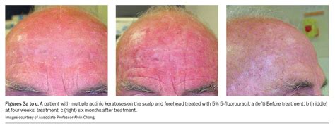 Actinic Keratosis An Update On Management Medicine Today