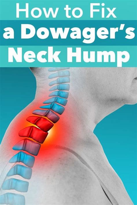 3 Exercises To Help You Quickly Get Rid Of A Dowager S Neck Hump