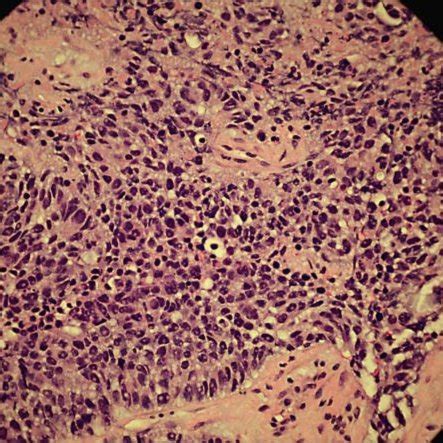 Photomicrograph Of Liver Biopsy Illustrating A Metastatic Papillary