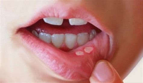 Reason Behind Mouth Ulcer And Tips To Cure Them Amar Ujala Hindi News Live मुंह के छाले से