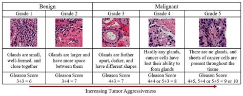 Gleason Scores And Prostate Cancer Grading System The Gleason Score