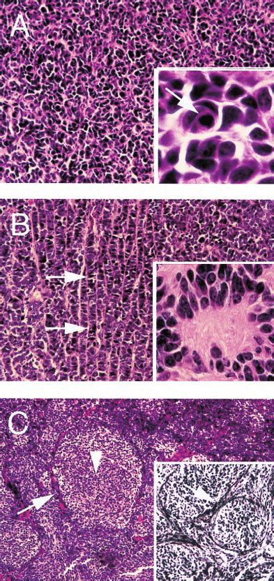 Medulloblastoma Histology