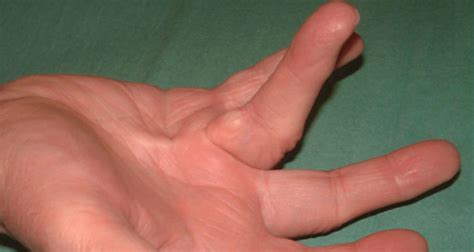 Dupuytren S Contracture Causes Symptoms Treatment