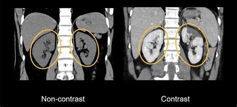 Lung Ct Scan Without Contrast