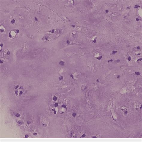 Histological Features Of The Low Grade Chondrosarcoma At Magnification