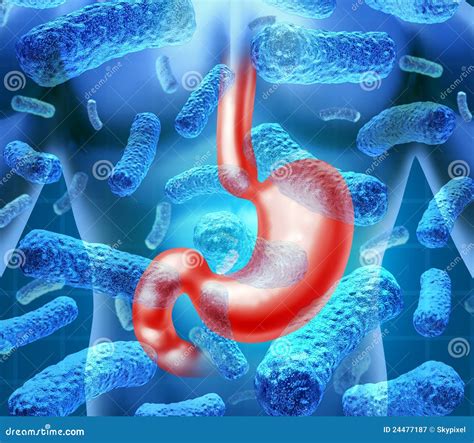 Stomach With Bacterial Gastroenteritis Vector Illustration ...