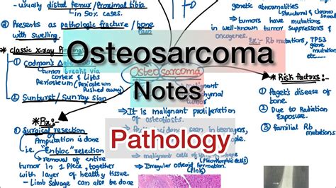 Osteosarcoma Pathology Simple Youtube