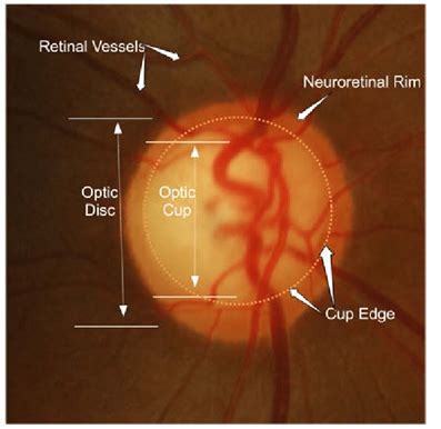 Optic Atrophy Optography