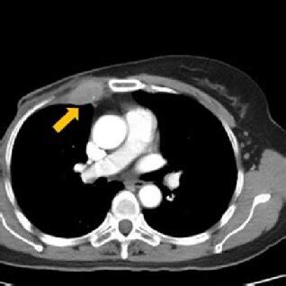 Metastatic internal mammary lymph nodes (IMLNs, yellow arrows) detected ...