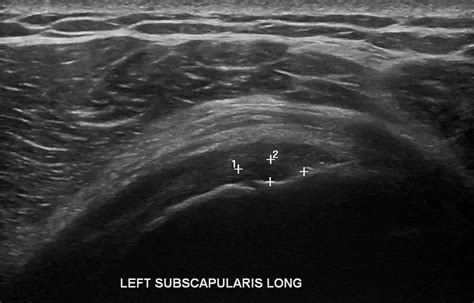 Shoulder Ultrasound Diagnostic Imaging Melbourne Radiology