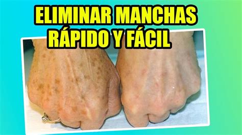 Cómo quitar las pecas de las manos lilimpieza