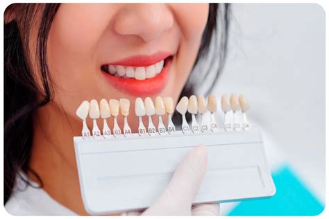 Everything You Need To Know About Dental Veneers