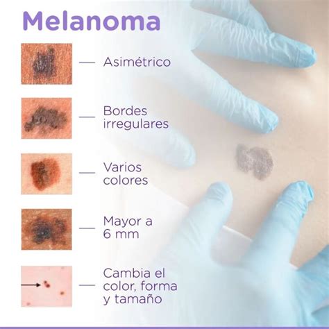 Sabes C Mo Diferenciar Un Lunar Normal De Un Melanoma Im Genes De